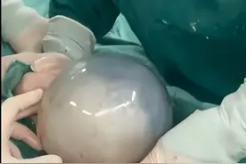 “带壳”宝宝火了，出生自带“金钟罩”保护，妥妥的哪吒转世图片