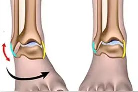 脚踝扭伤后，为啥总不好？很有可能是您忽视了这2个重要问题图片