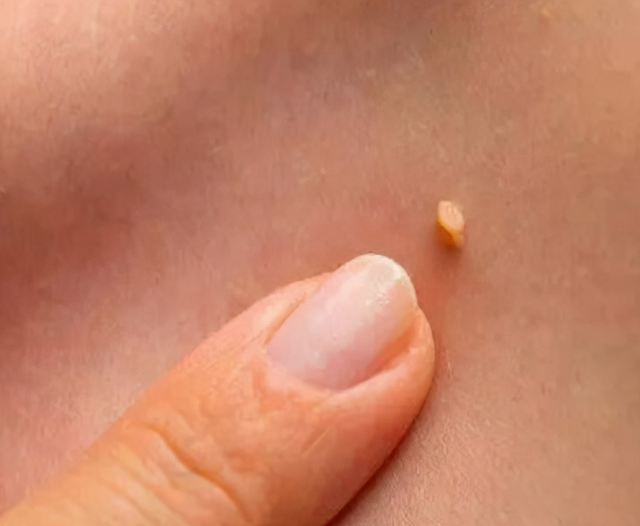 超过71%的人，不知道自己感染HPV！脖子和手臂有这几特征千万当心