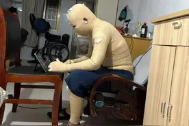 室友电池爆炸烧伤的大学生，绝望深渊里唱歌图片