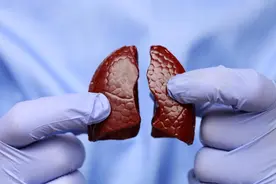 “无症状肺癌”冲上热搜！医生再次提醒：出现这些信号要警惕图片