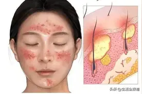 碘伏变身“美容神器”？讲真，千万不要乱涂碘伏！图片