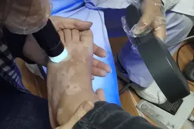 白癜风光疗1年 遇上“平台期” 2个方法应对图片