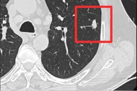 上海三甲医院做了穿刺为良性，但我认为基本上是错了，这是肺癌！图片