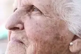 出现老年斑怎么办?巧用4个方法，还你一张干净无暇的脸图片