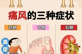 无论你哪类痛风，三妙二草痛风方加减，有奇效！图片