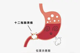 啥是十二指肠溃疡？你必须了解的常识图片