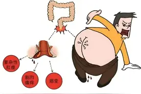 肛瘘痔疮区别大，别错把“肛瘘”当“痔疮”图片