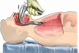 关于气管切开，你知道多少？图片