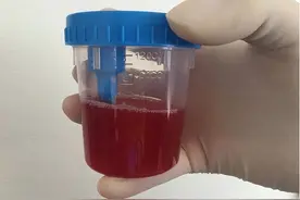 以为是上火，结果却是癌！这几种颜色的尿液预示身体出了问题！图片