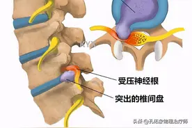 腰椎间盘突出压迫坐骨神经痛，怎么办？图片