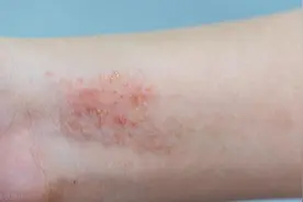 虫咬皮炎如何诊治图片