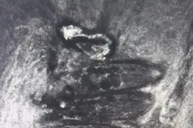 13岁少年双眼竟成“螨虫窝”！医生提醒：这个习惯最招虫图片