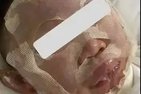 江苏常州小学课堂做实验爆炸致4名学生烧伤！涉事教师被停止教学图片