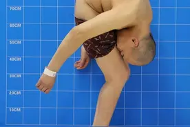 “折叠人”李华，骨头被敲断4次，植入22颗钢钉，如今重获新生图片