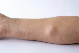 脂肪瘤会变恶性肿瘤吗？应该看什么科？图片