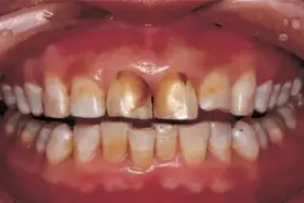 牙黄、烟渍如何洁牙？过来人给你支一招，顽固牙渍都能越刷越白！图片