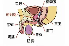 体检发现前列腺钙化，怎么办？图片