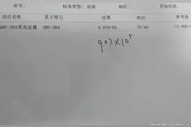 乙肝随年龄自然转阴是真的吗？医生：乙肝转阴需要基于这3点图片