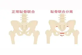 长治二院：孕期耻骨联合分离之痛别害怕，盆底康复来帮忙图片