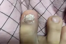 告别灰指甲，我用了这招！不藏私分享我的灭灰绝技，效果惊人！图片