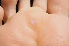 脚上长的是鸡眼、瘊子，还是老茧，你搞清楚了吗？图片