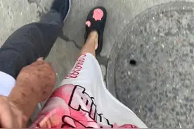 爷爷帕金森干细胞治疗后续图片