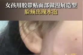 女孩用胶带贴面部做漫展造型，脸颊出现水泡图片