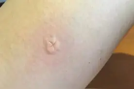 经常被蚊虫叮咬怎么办？教你一个最快止痒，以及驱蚊的办法图片