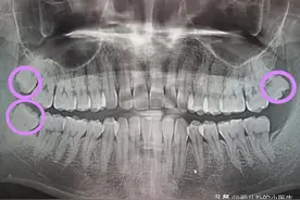 拔掉的智齿为什么不让带走？图片