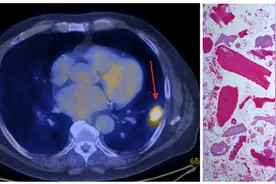 撞大运!三位癌症患者不药自愈实录:逆天好运的患者都是什么样的？图片
