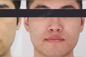 全牙列反颌（地包天），掩饰性正畸做到咬合最好。图片