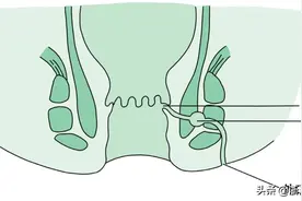 内裤总是湿湿的，还有臭味，是怎么回事？图片