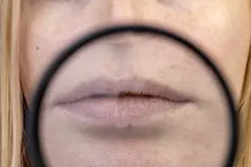 嘴唇总干裂、起皮？可能是这3种疾病，注意提高警惕图片