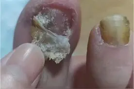 过来人血泪教训！灰指甲千万别拖，一个方法教你在家摆脱它！图片