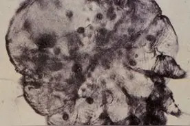 疥疮像条龙，先在手上行，腰中绕三圈，腿上扎大营，小心中招图片