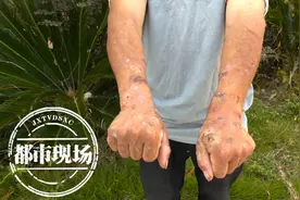 别再只涂药膏！被红火蚁咬伤后，这样处理很重要图片