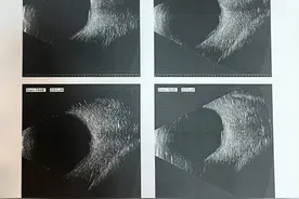 济南市莱芜人民医院：眼科妙手施术为96岁失明患者重启光明“视”界图片