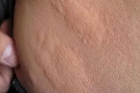 荨麻疹三种常见分类，如何治疗？可以自愈吗？图片