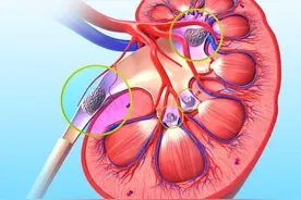 肾结石、输尿管结石微创术后，为什么要“放管子”？图片