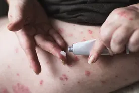 湿疹反复发作，他克莫司软膏能否成为你的终极解药？图片