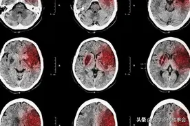 脑梗死病人出现4种情况，必须马上住院，否则生命可能有危险图片