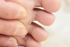 六大神器赶走香港脚！皮肤科医生推荐的抗真菌药清单图片