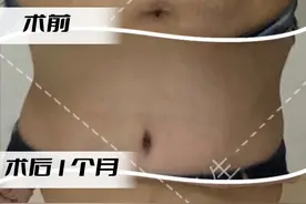 大实话：腹壁整形VS腰腹环吸,希望你不是最后一个知道它们的区别图片