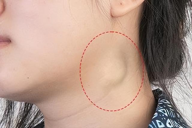 医生提醒：体检报告出现这几个字，距离癌症可能只有“一步之遥”