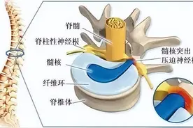 腰间盘突出光吃药可不行，教你4个动作，多训练才能好的快！图片
