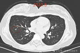 磨玻璃肺癌会遗传？传女不传男？微浸润性腺癌有15%活不到五年？图片