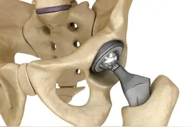 人工髋关节置换手术后康复，看这一篇就够了…图片