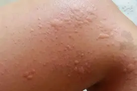 荨麻疹，湿疹皮炎，到夏天反复瘙痒？老中医从根清热毒，止住瘙痒图片