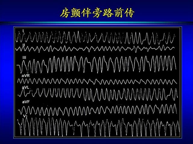 室性心动过速的体表心电图鉴别诊断